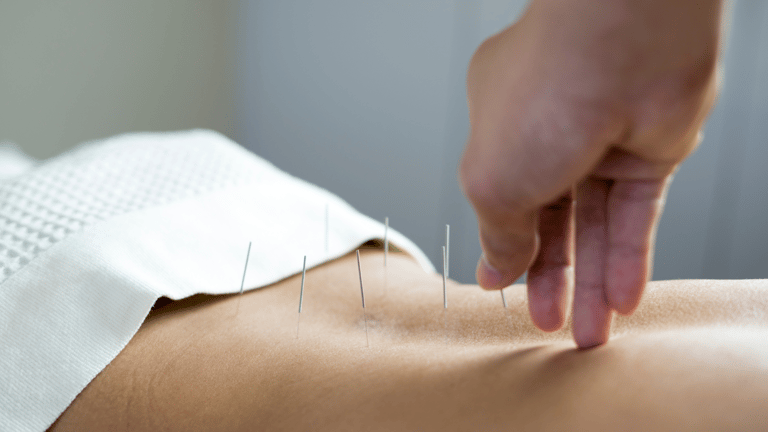 Une séance d'acupuncture, sur le dos
