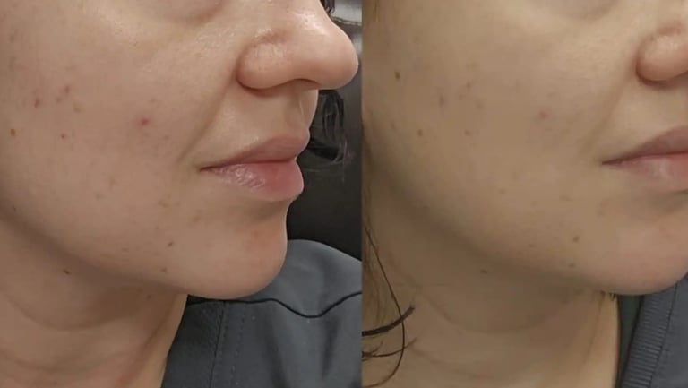 KINVIVE by Juvederm treatment at Ariana Esthetic Edmonton