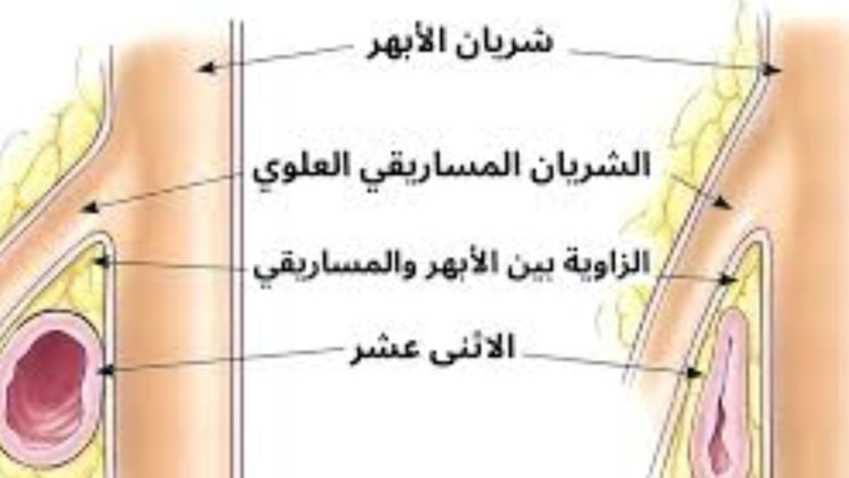 القيء من انسدادات الجهاز الهضمي العلوي