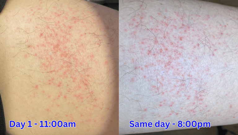 Red spots on thigh: picture left shows moderate amount 11am, pic right shows more severe 8pm
