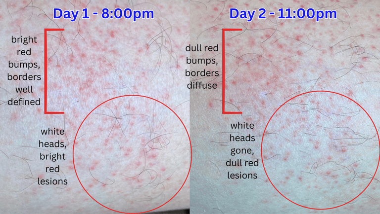 Bright red spot day 1, dull red spots day 2