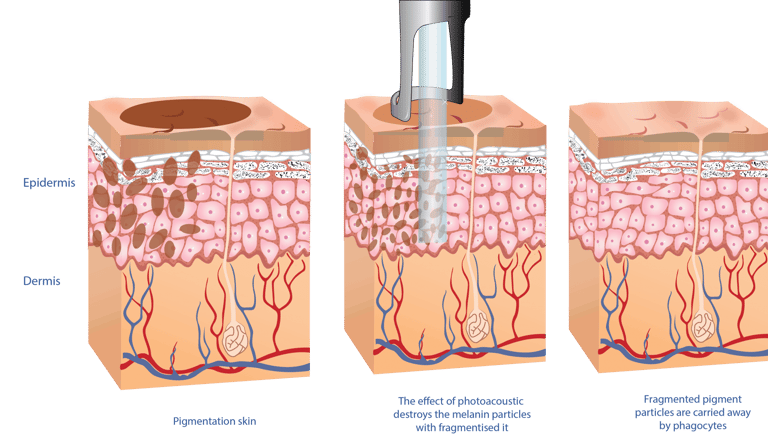 pico laser pigmentation diagram