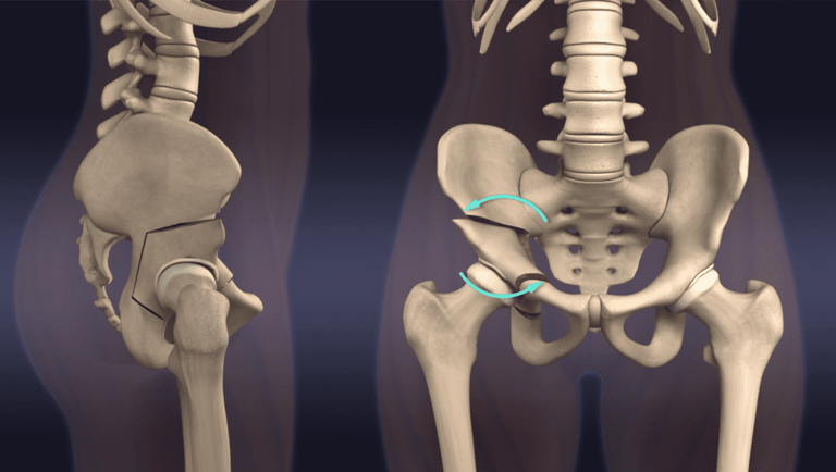 Osteotomia de Ganz, Berna, ou PAO.