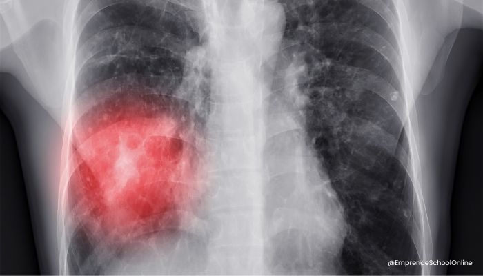 Enfermedades producidas por el polvo de uñas - Neumonitis