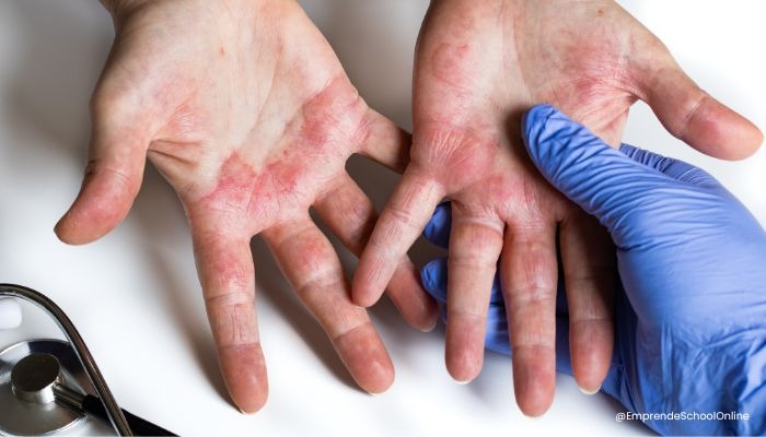 Enfermedades producidas por el polvo de uñas