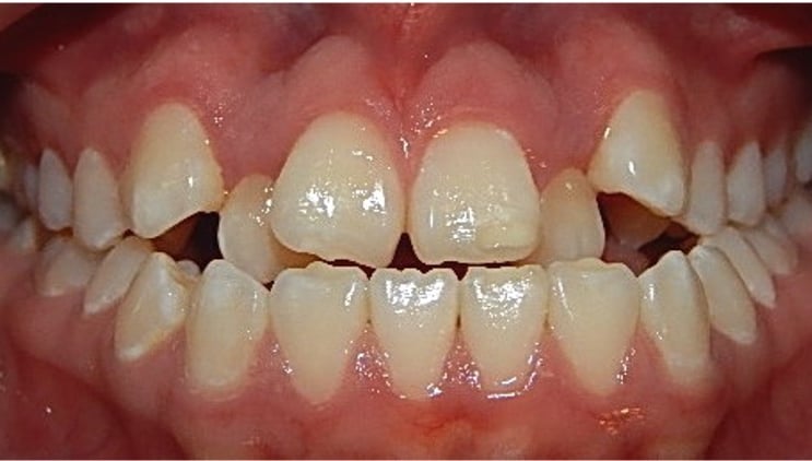 Close Up de una sonrisa con apiñamiento severo.