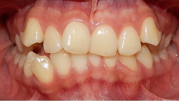 Sonrisa con malposicion dental