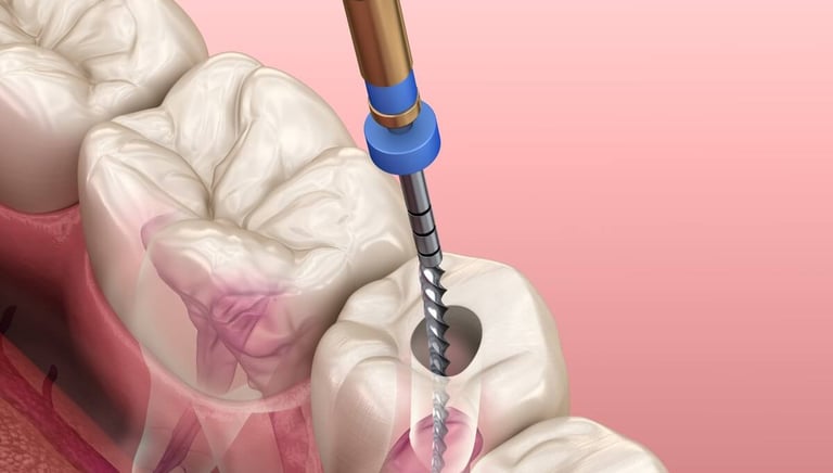 root canal treatment specialist