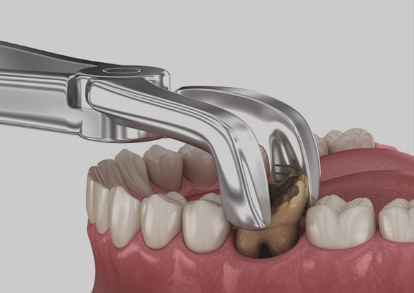 tooth replacement surgery baner