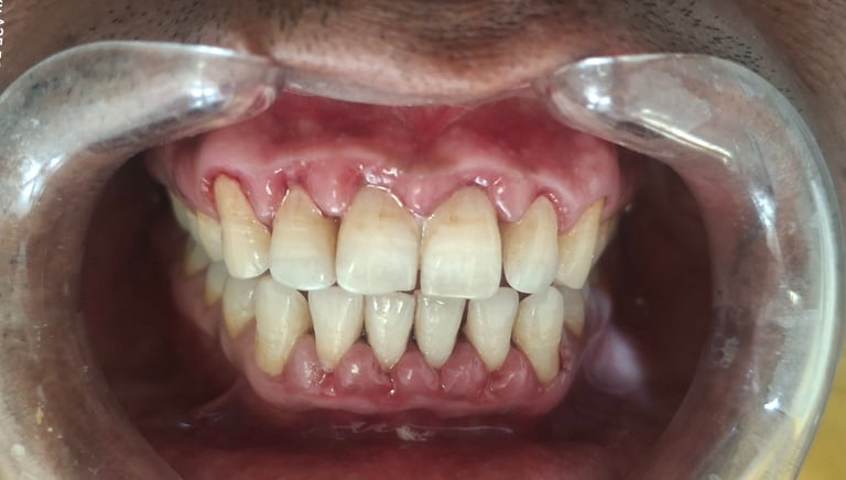 After scaling showing visibly brightened enamel at Shree Dental Care Shyamal Ahmedabad