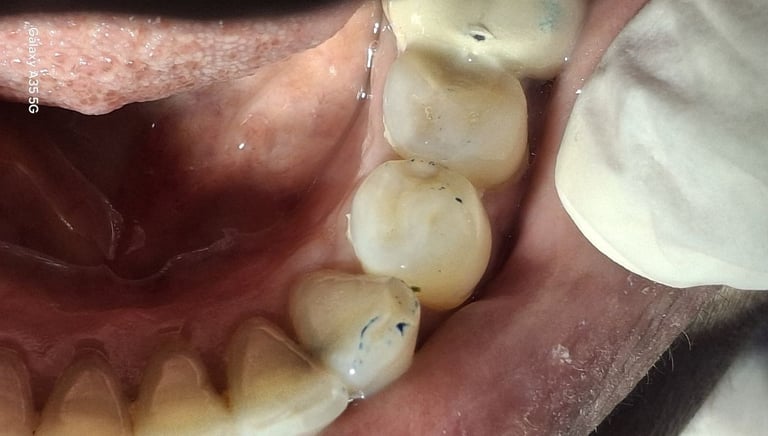 after root canal treatment and proper filling at shree dental care near shyamal