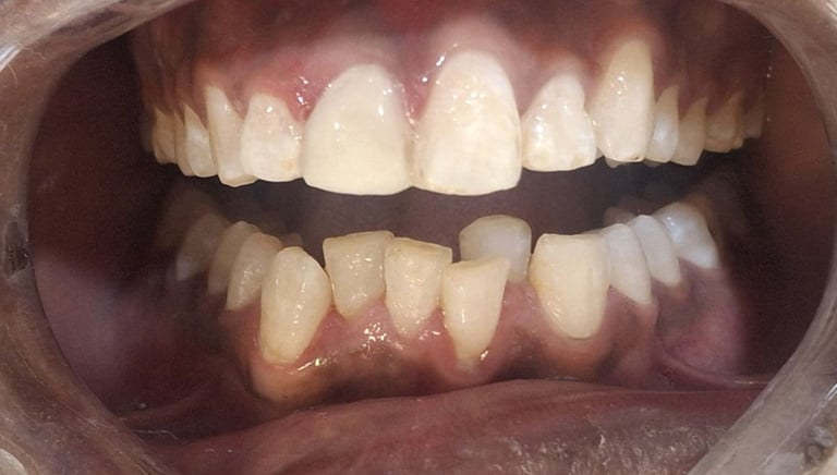 after tooth colored filling restored smile and function at shree dental care near satellite