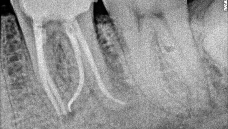 Healthy restored molar after root canal treatment at shree dental care