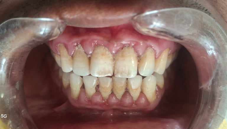 Before scaling showing yellow surface stains from tea and coffee consumption in Shyamal Ahmedabad