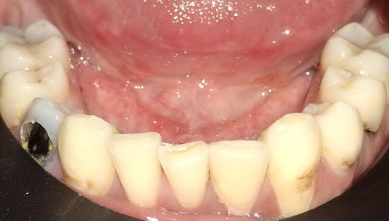 before rct showing carious front teeth at shree dental care ahmedabad