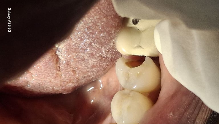 before root canal treatment carious tooth showing pain and food lodgement at shree dental care
