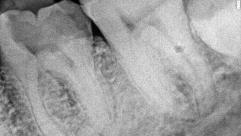 Deep cavity in molar tooth before root canal treatment at shree dental care