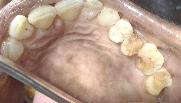 broken upper back molar tooth requiring rct before crown at shree dental care