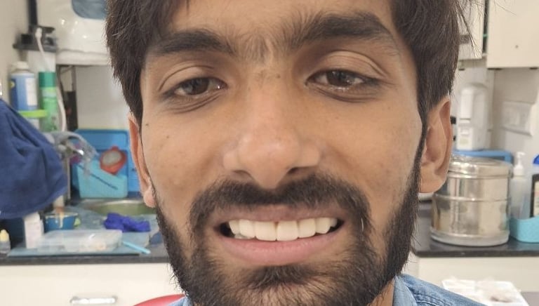 After image of complete mouth restoration with improved oral health aesthetics in Shree Dental Care