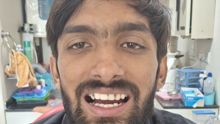 Before image of complete mouth restoration case with multiple dental issues shree dental care