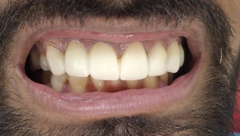 Full mouth rehabilitation after treatment showing healthier smile and function at shree dental care