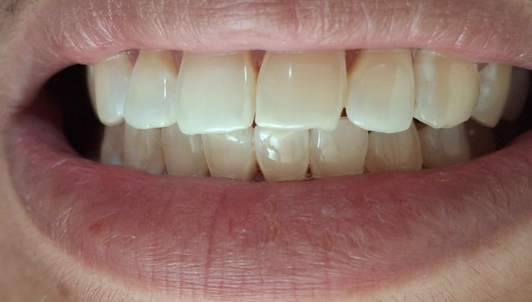 After whitening showing refreshed and brighter smile at Shree Dental Care Shyamal Ahmedabad