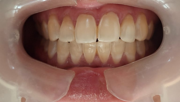 Before whitening showing dull enamel appearance with generalized yellowing in Shyamal Ahmedabad