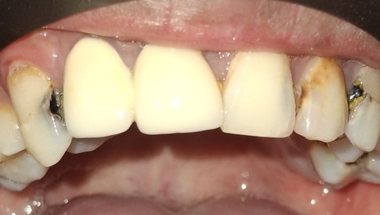 before rct showing severe carious upper front teeth at shree dental care