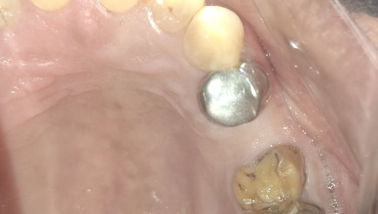 loss of old crown and hypersensitivity of upper back tooth at shree dental care