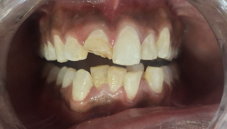 broken front tooth before tooth colored fillings at shree dental care near satellite