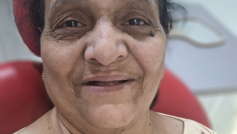 Bite collapse and worn teeth before full mouth rehabilitation treatment in Ahmedabad