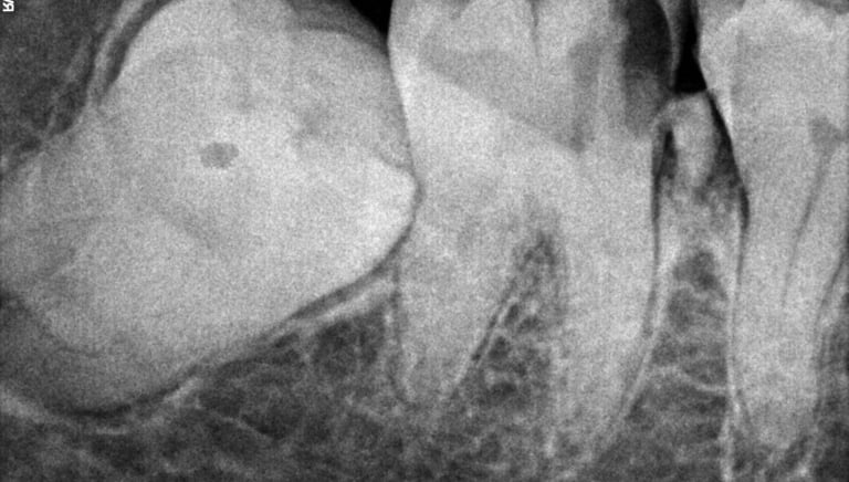 real xray of patient with impacted third molar at shree dental care near shyamal ahmedabad