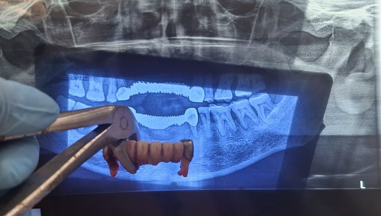infected old bridge removed under proper aseptic technique at shree dental care