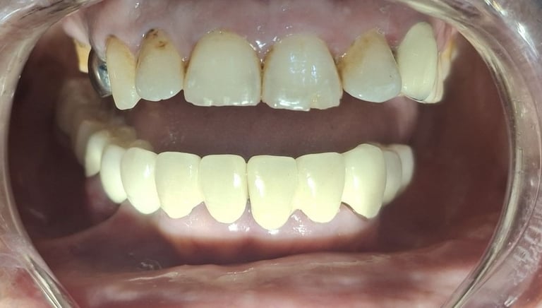 Multiple teeth restored after full mouth rehabilitation improving chewing efficiency at shree dental