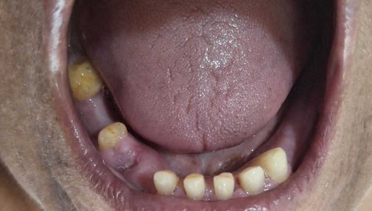 Loss of oral function and uneven teeth before full mouth rehabilitation at Shree Dental Care