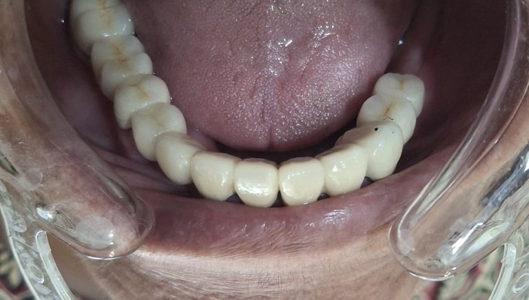 Restored oral function and improved bite after full mouth rehabilitation in shree dental care