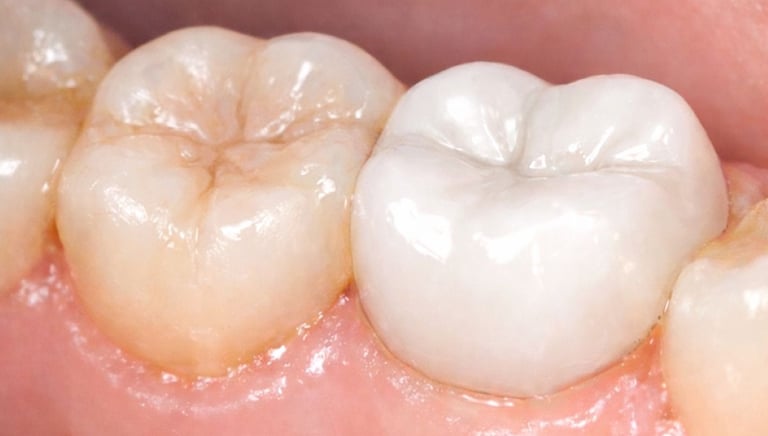 Pain-free tooth after root canal treatment and crown near shyamal at shree dental care