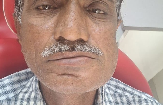 Tooth infection with swelling requiring root canal treatment at shree dental care near shyamal