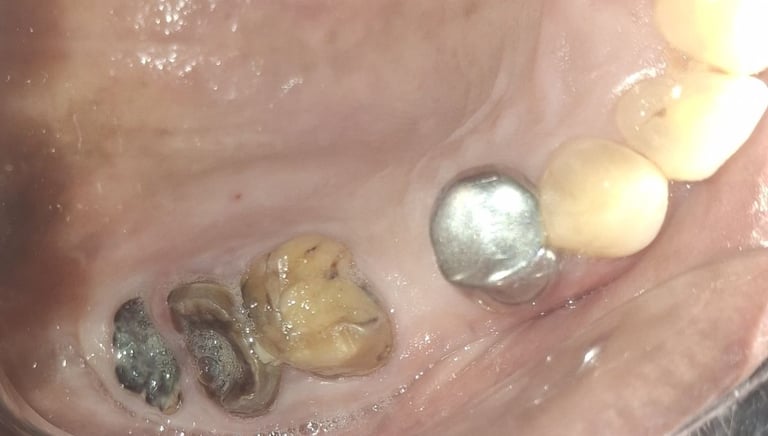 clinical image of root pieces in mouth st shree dental care