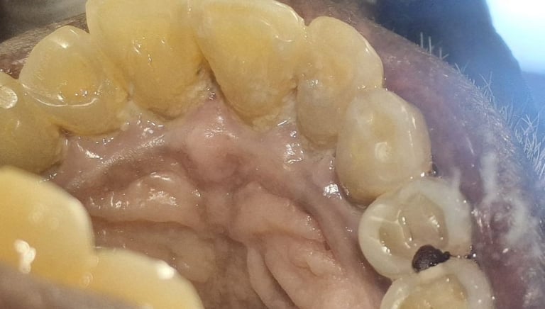 deep caries in tooth with pain and chewing problem at shree dental care
