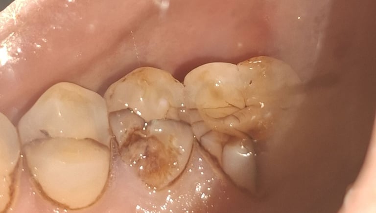 multiple cracks and fracture of tooth part with severe pain at shree dental care