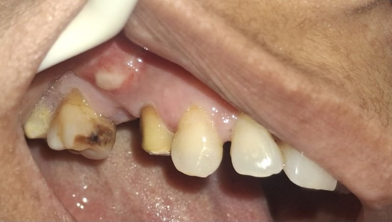 swelling in bone near molar teeth due to long term caries requiring tooth extraction