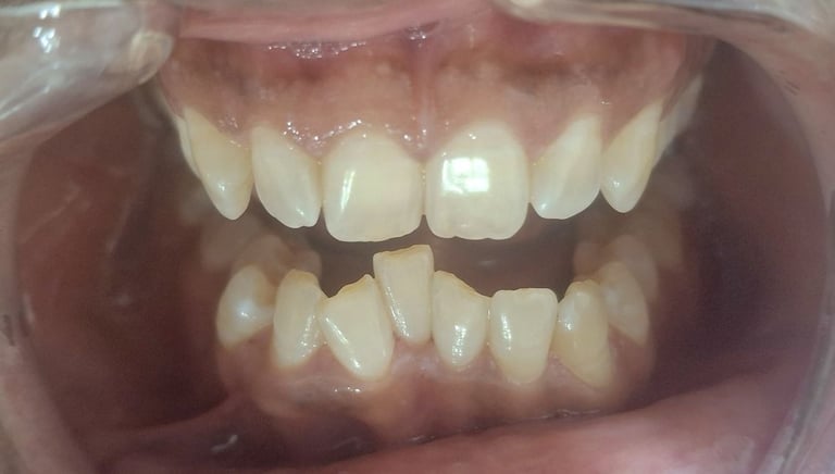 teeth cleaning results for mild crooked teeth at shree dental care near shyamal