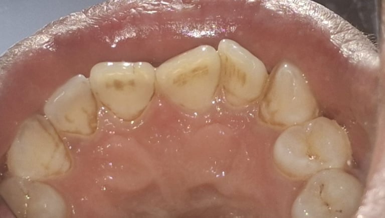 Teeth cleaning result showing tartar buildup before treatment near Shyamal shree dental care