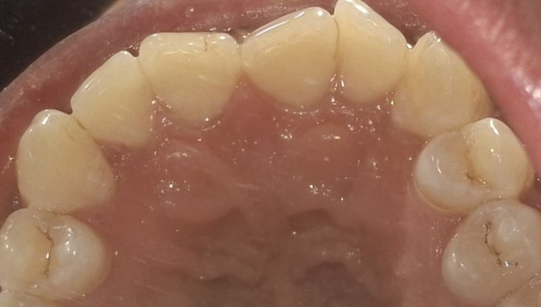 Teeth cleaning result after removal of tartar and deposits near Shyamal at shree dental care