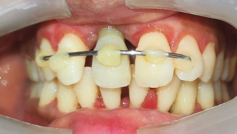  Teeth cleaning result healthy teeth and gums after proper cleaning  shree dental care near shyamal