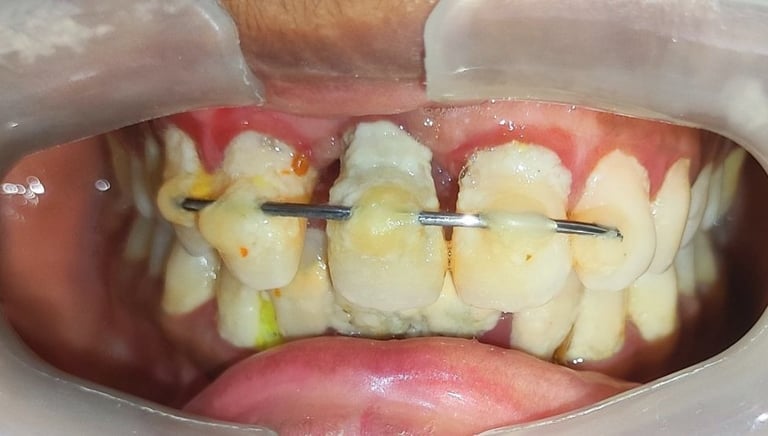  Teeth cleaning results plaque deposits on gumline before cleaning near Shyamal at shree dental care