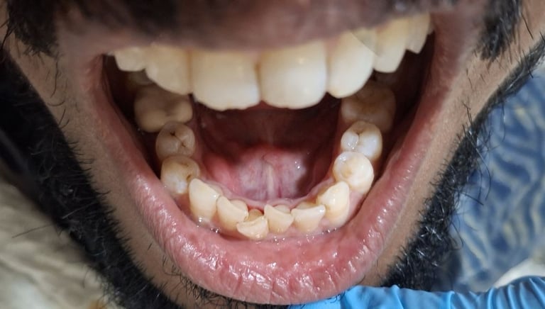  Teeth cleaning result after removal of tobacco stains at shree dental care near shyamal