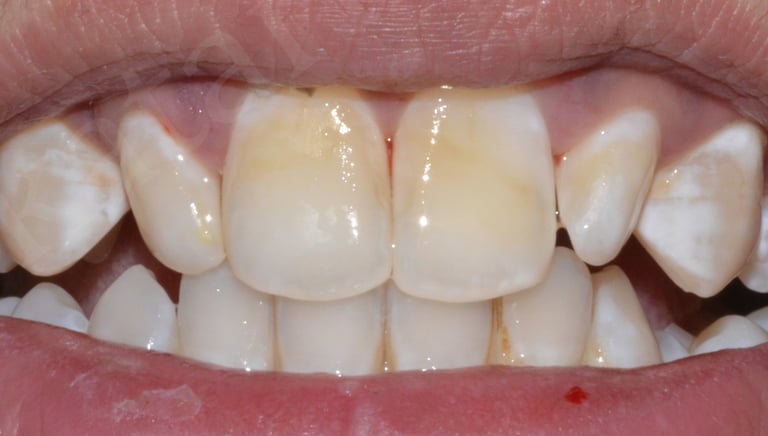 After whitening showing blended shade and improved appearance at Shree Dental Care Shyamal Ahmedabad