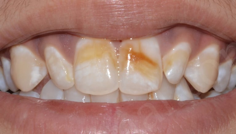 Before whitening showing deep fluorosis spots in Shyamal Ahmedabad